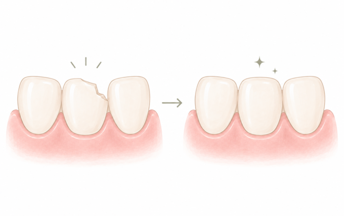 Comment réparer une dent cassée ?