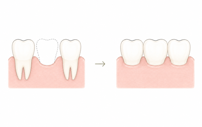 Comment remplacer une dent manquante ?