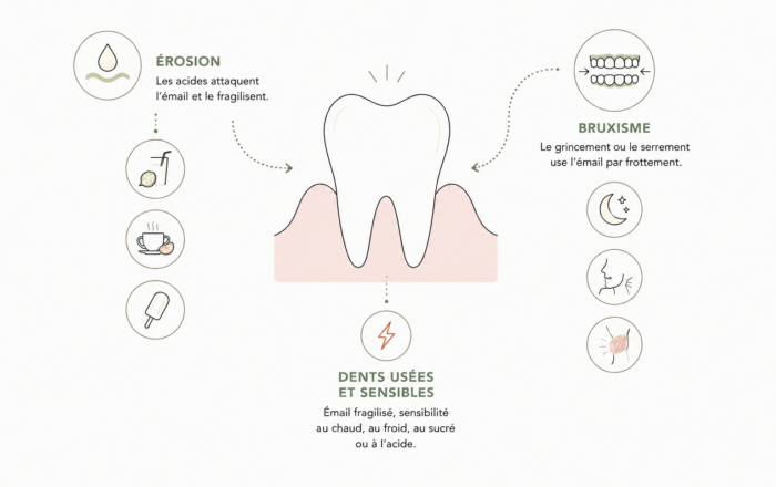 Dents usées et sensibles : comprendre l&rsquo;érosion et le bruxisme