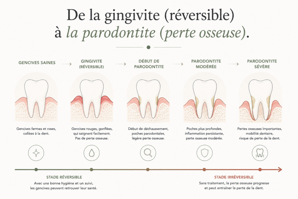 Schéma de l’évolution vers la parodontite.